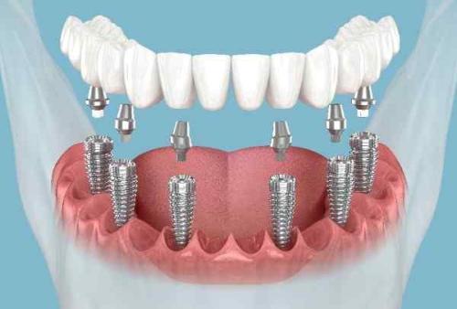 Dental implants Stockport