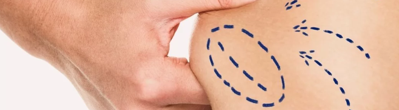 Liposuction Surgery
