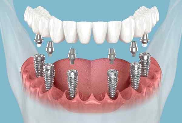 Dental implants Stockport