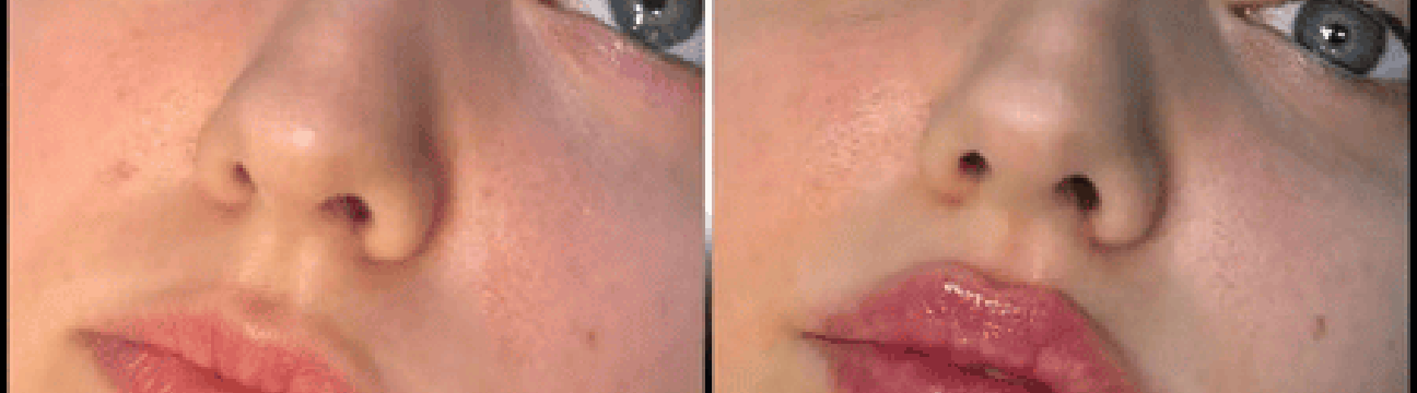 Dermal Fillers